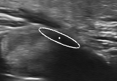 Carpal Tunnel Syndrome Segmentation